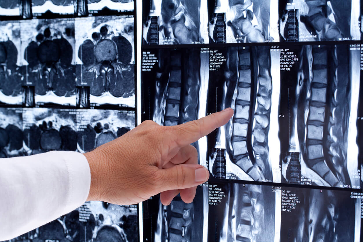 Spinal Cord Injuries doctor pointing to spinal cord xrays